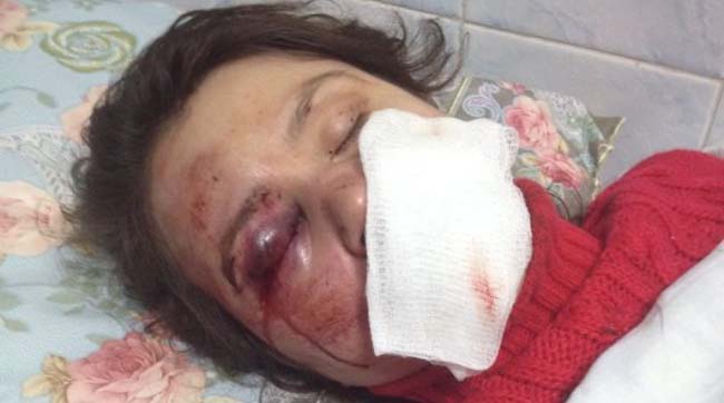 Татьяна Черновол после зверского избиения. Фото blogs.pravda.com.ua tatyana chernoovol